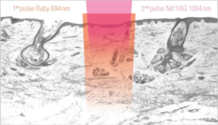 Asclepion NanoStar C для удаления тату ➜ Купить лазер для удаления татуажа в Украине | Alfaspa изображение 17